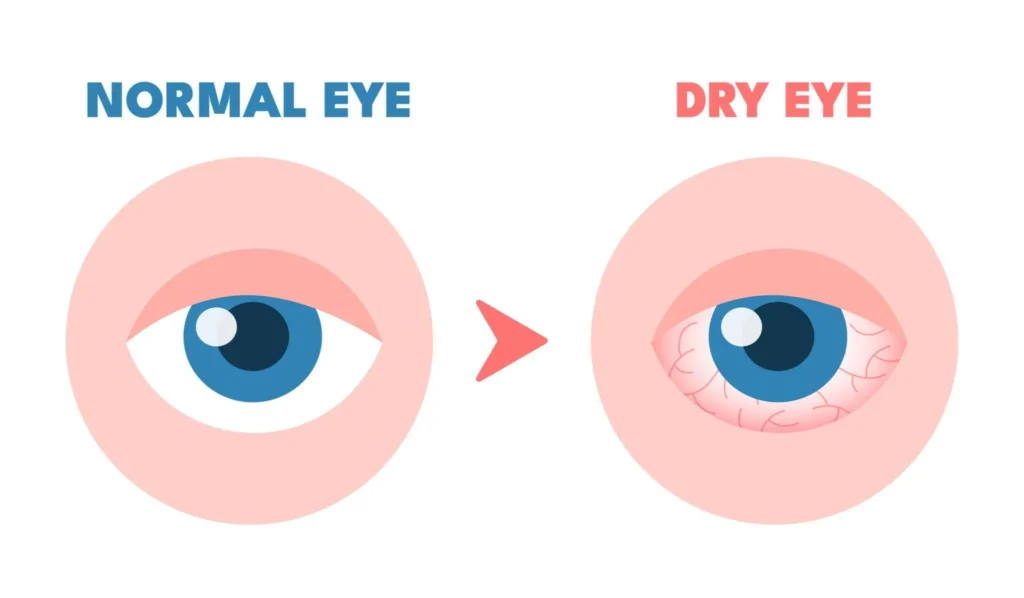 Red Eyes Causes: Why Your Eyes Turn Red and What to Do About It red eye causes